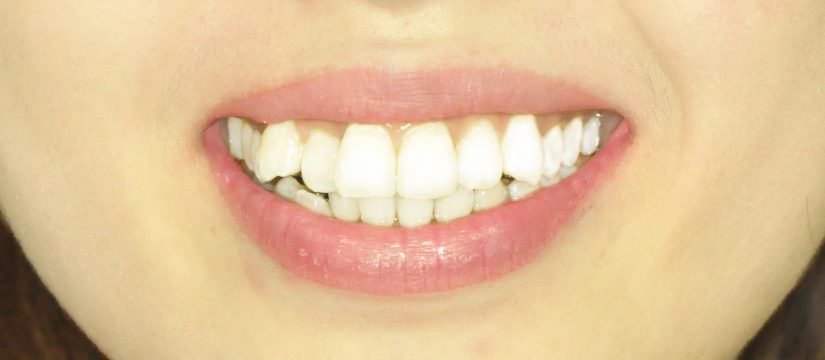 niềng răng mặt trong tại hà nội