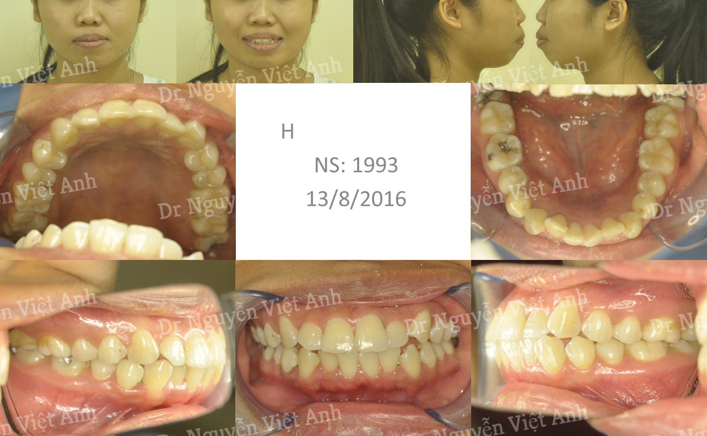 niềng răng mặt trong tại hà nội