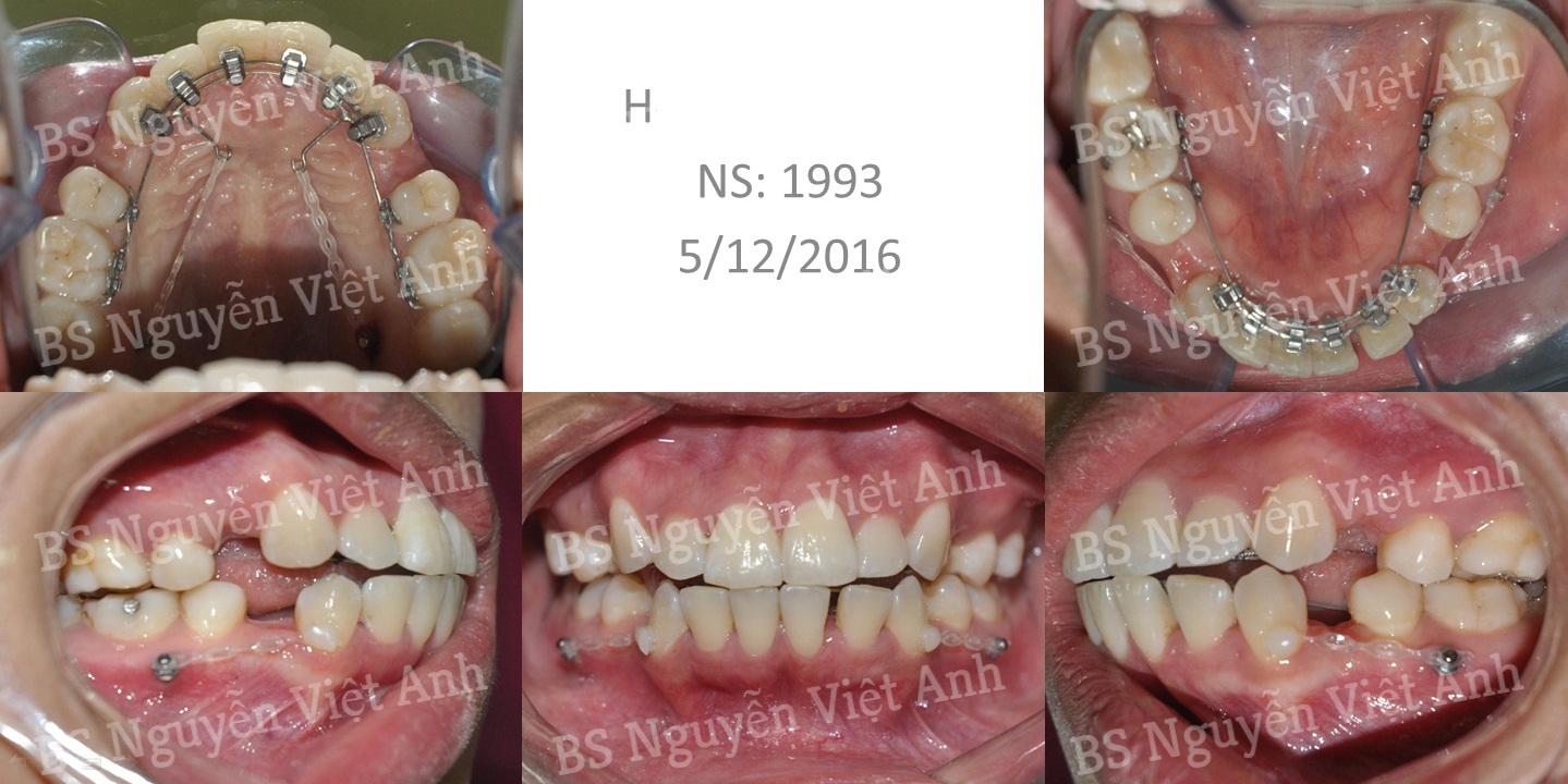 niềng răng mặt trong tại hà nội 1