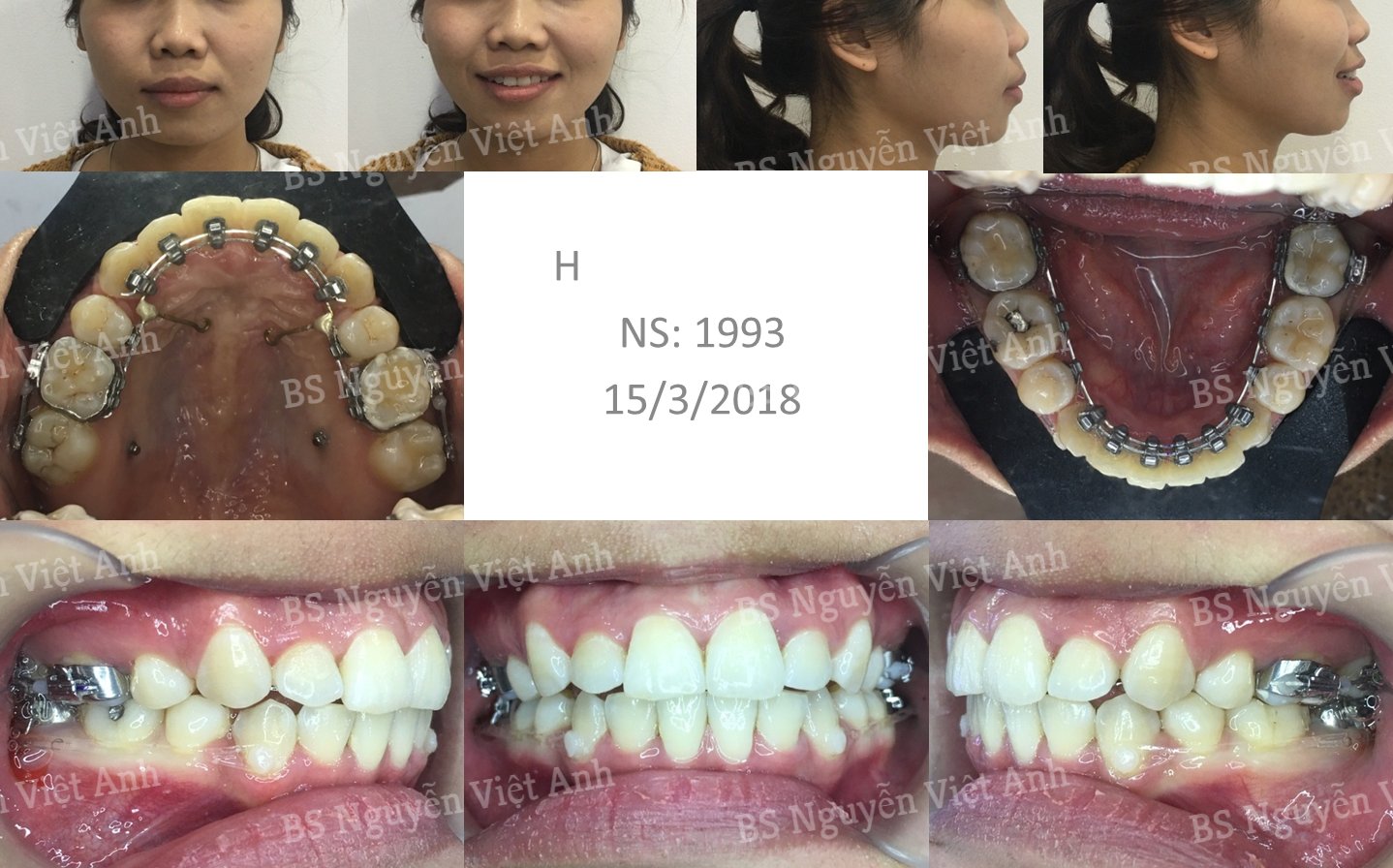 niềng răng mặt trong tại hà nội 2