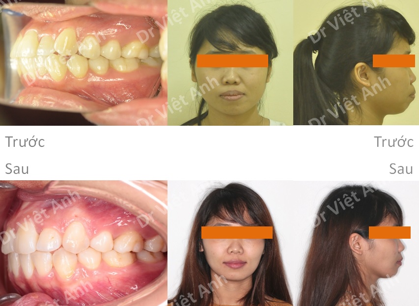 niềng răng mặt trong tại hà nội 4
